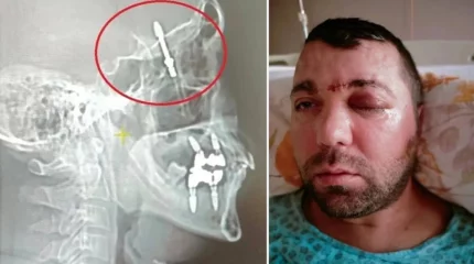 Тіс дәрігері науқастың имплантын қатты бұрап, миына кіргізіп жіберген