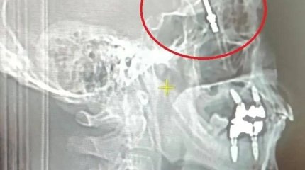 Турецкий стоматолог вкрутил имплант в мозг пациенту
