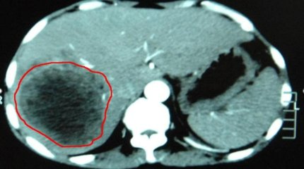 Гигантскую шестикилограммовую опухоль вырезали у жительницы Жамбылской области