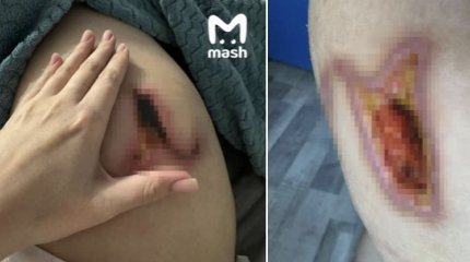 Массаж до дыр: девушке прожгли ногу во время процедуры