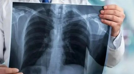 Қостанай облысында туберкулезбен ауыратындар саны артты