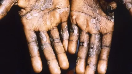 Швецияда маймыл шешегін жұқтырған бірінші адам тіркелді