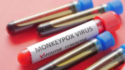 Маймыл шешегі: қауіпті вирусты анықтайтын ПЦР-тест елге жеткізілмек