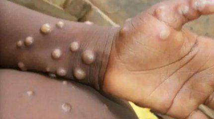 Елімізге маймыл шешегі еніп кетпес үшін қандай шаралар жасалып жатыр