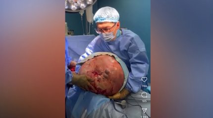 Алматыда дәрігерлер науқастан 30 келі қатерлі ісікті алып тастады