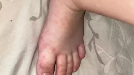 Есіл қаласында балалар арасында белгісіз індет тарады