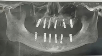 Бір күнде 23 тісін жұлдырып, 12 имплант салғызған ер адам қайтыс болып кетті