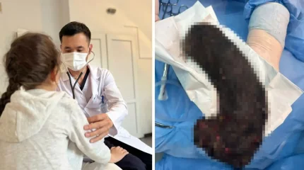 Алты жасар қыздың асқазанынан бір келі ұйысқан шаш шықты