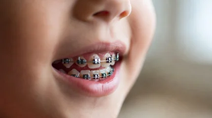 Слух про бесплатные брекеты детям по ОСМС не подтвердился - ФСМС дала разъяснение