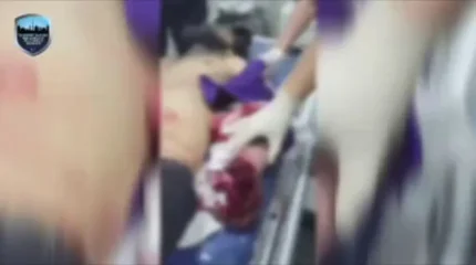 Школьник из Ташкента остался без пальцев после взрыва пиротехники