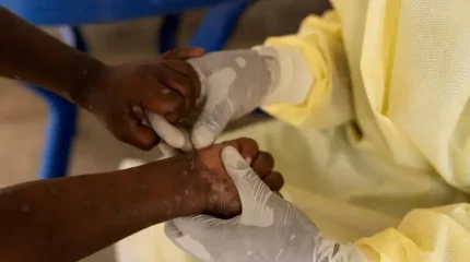 Конгода маймыл шешегімен ауырған 128 адам емдеу орталықтарынан қашып кетті