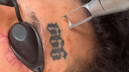 С чистого лица: Моргенштерн удаляет тату (ВИДЕО)