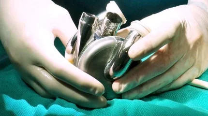 Мужчина прожил 100 дней с искусственным титановым сердцем в ожидании донора