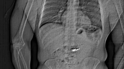 Американец проглотил серьги за $770 тысяч, пытаясь скрыть преступление