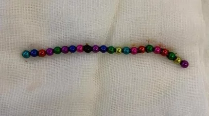 Магнитного «червя» извлекли хирурги из желудка ребёнка в Караганде