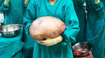 Медики приняли за беременность: у женщины нашли 8-килограммовую кисту