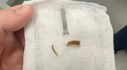 11 айлық сәбидің өкпесінен металл табылды