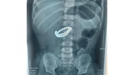 Алматыда 31 магнит жұтып қойған бір жасар балаға шұғыл ота жасалды