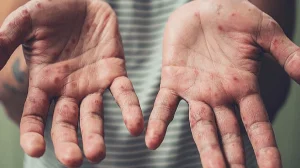 Алматыда 400-ден астам бала қызылша жұқтырған